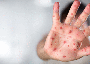 Yeni Mpox Varyantı Korkutuyor!