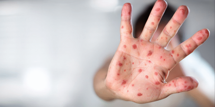 Yeni Mpox Varyantı Korkutuyor!