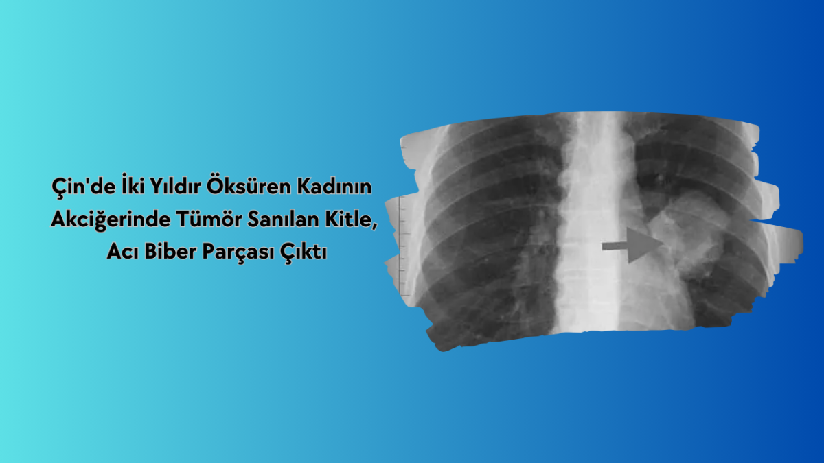 Çin'de İki Yıldır Öksüren Kadının Akciğerinde Tümör Sanılan Kitle, Acı Biber Parçası Çıktı